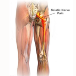 درد-سیاتیک-یا سیالژی