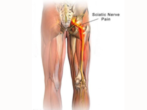 درد-سیاتیک-یا سیالژی