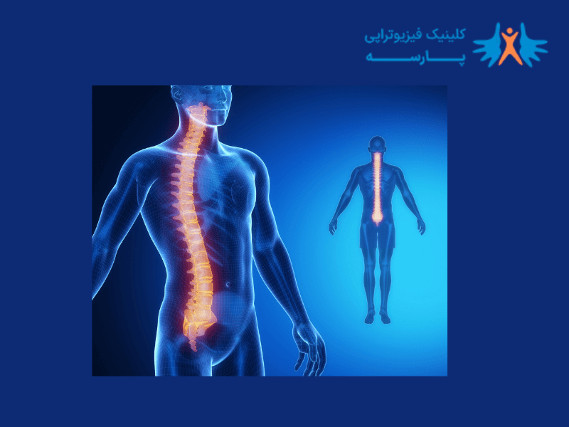 انحراف-ستون-فقرات-چیست