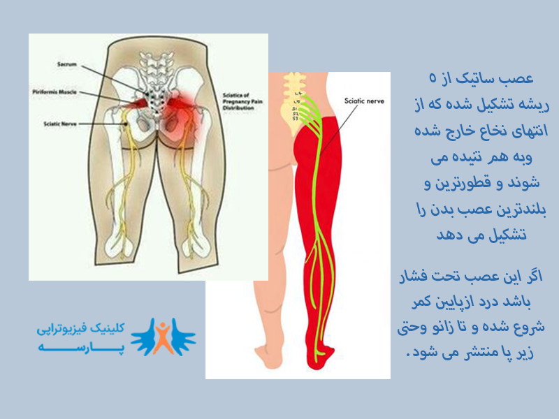 سیاتیک ناشی از فتق دیسک