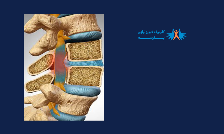 تفاوت دیسک کمر و سیاتیک-دکتر محمود اکبری