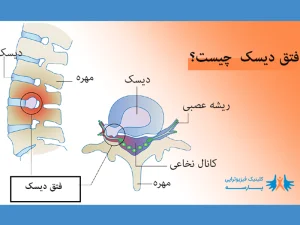 فتق دیسک- دکتر محمود اکبری