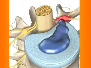 فیزیوتراپی فتق دیسک کمر