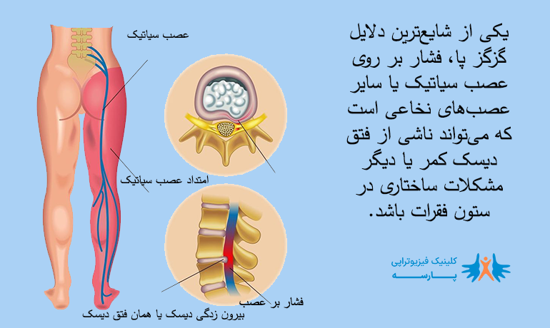 گزگز پا به دلیل عصب سیاتیک و دیسک کمر