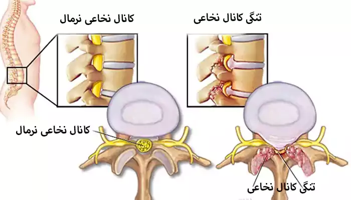 تنگی کانال نخاعی