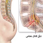 درمان کانال نخاعی با لیزر پرتوان