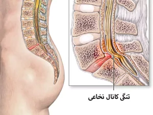 درمان کانال نخاعی با لیزر پرتوان