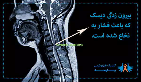 درمان بیرون زدگی دیسک با لیزر پرتوان