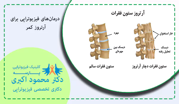 درمان‌های فیزیوتراپی برای آرتروز کمر